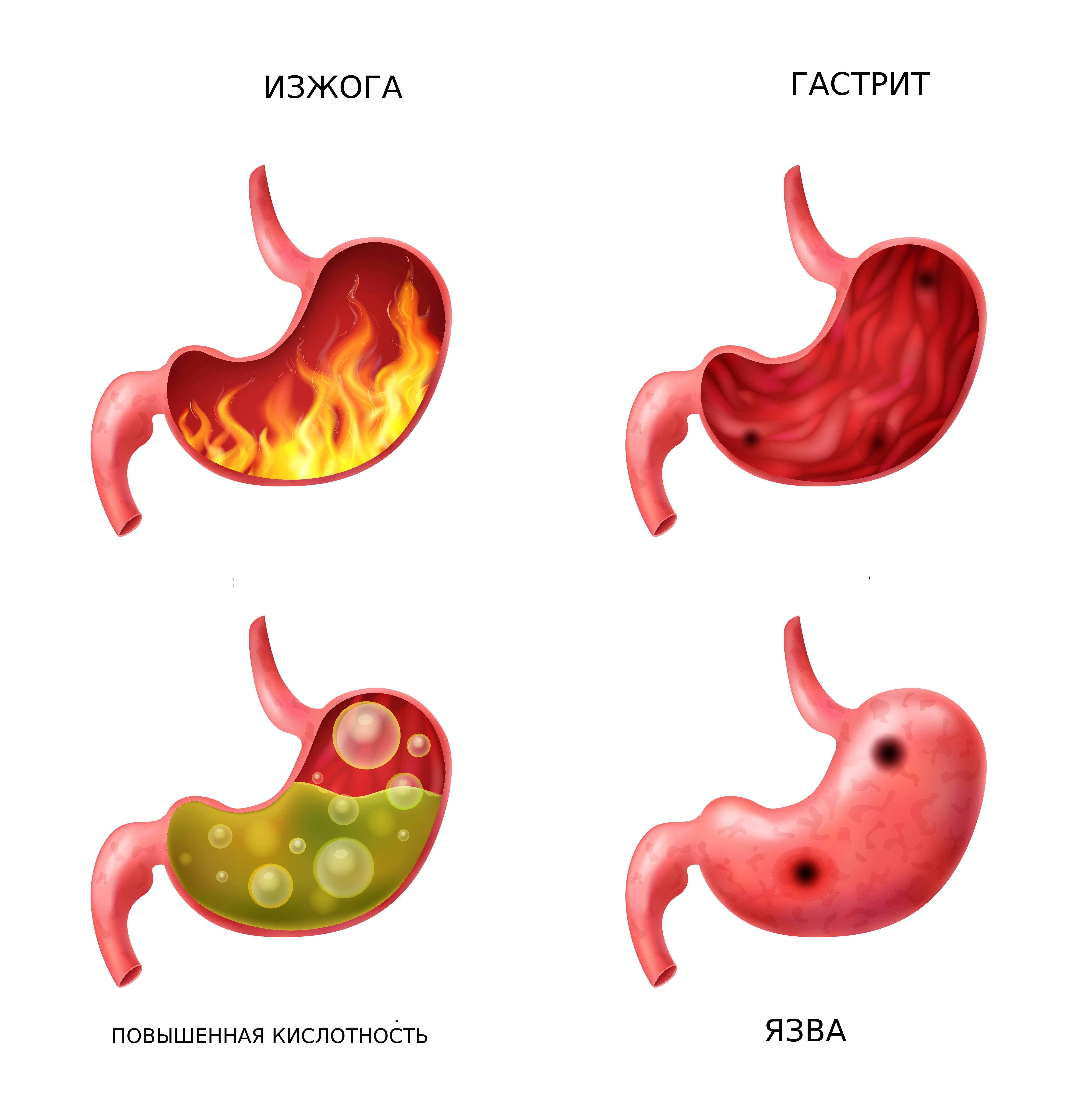 ФГДС желудка