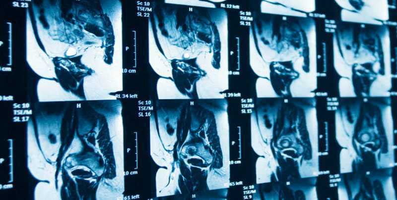 результаты мрт органов малого таза