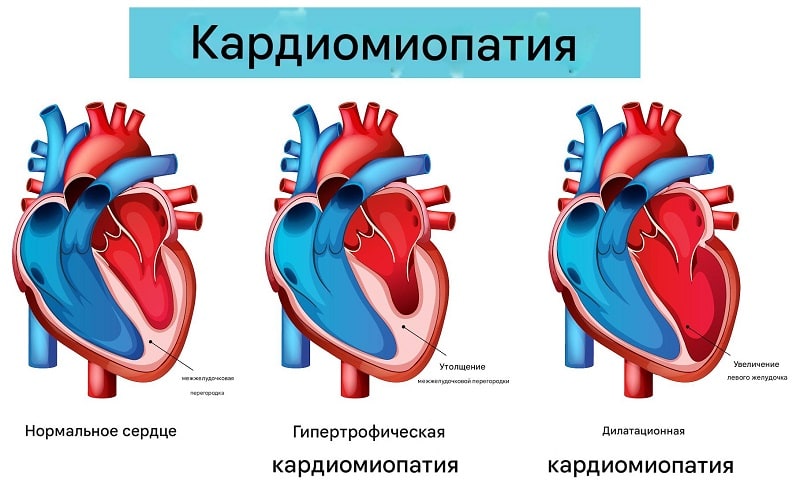 Кардиомиопатия сердца