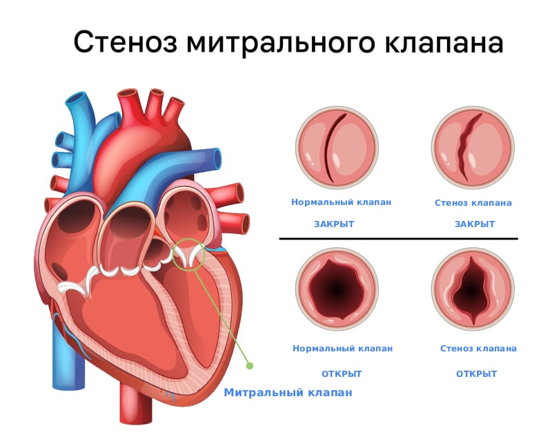 Стеноз митрального клапана