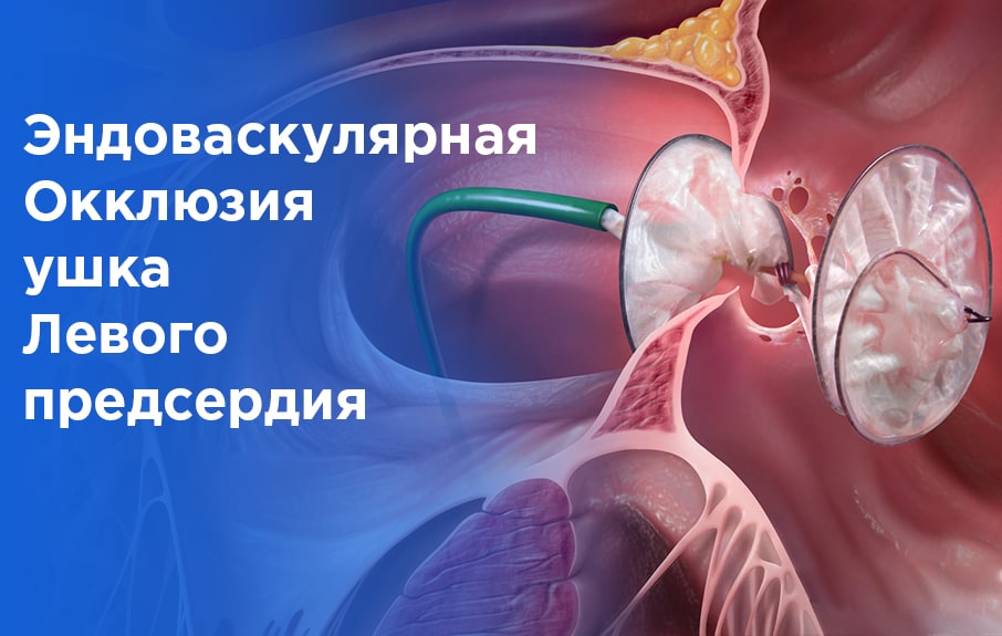 Эндоваскулярная Окклюзия ушка Левого предсердия