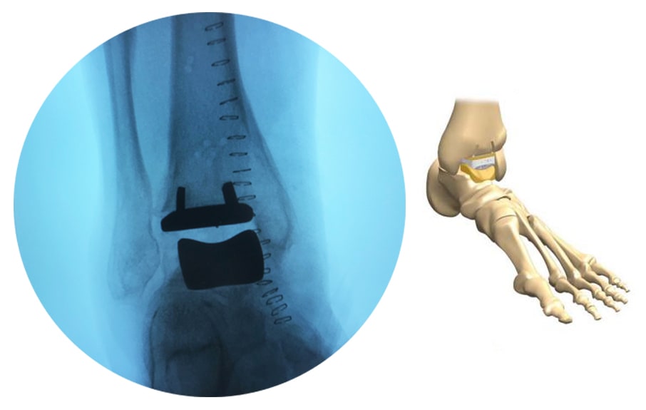 Травматологи-ортопеды МРМЦ впервые на Крымском полуострове провели тотальное эндопротезирование голеностопного сустава!