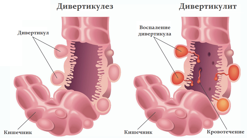Дивертикулит симптомы