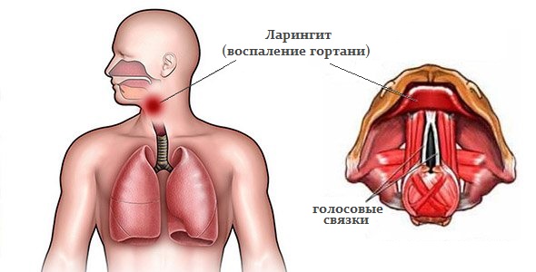 ларингит