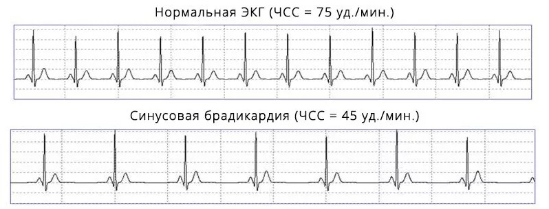 Брадикардия сердца что это