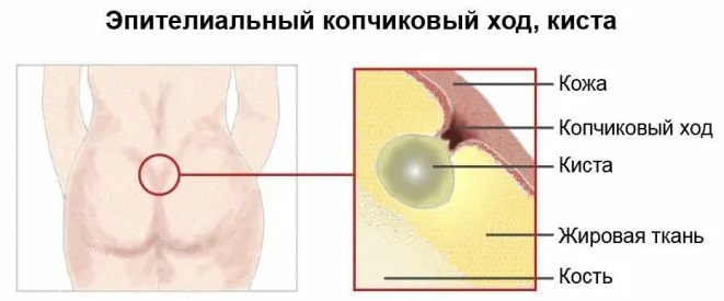 Копчиковая киста
