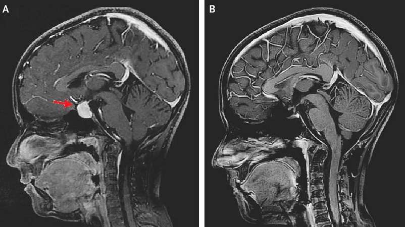 Лечение аденомы гипофиза