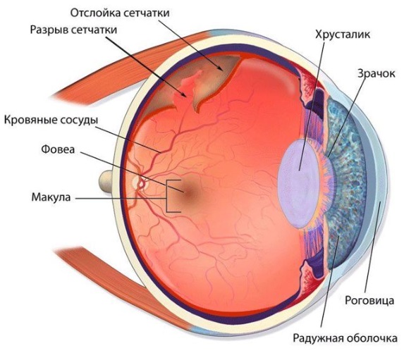 разрыв сетчатки