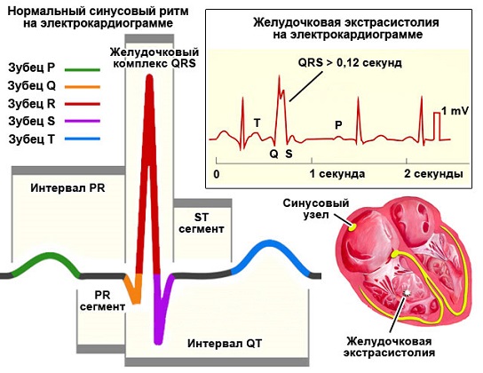 желудочковая экстрасистолия желудочковая экстрасистолия