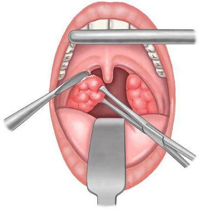 Тонзиллэктомия Тонзиллэктомия