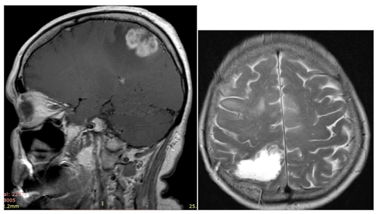 Опухоль в голове