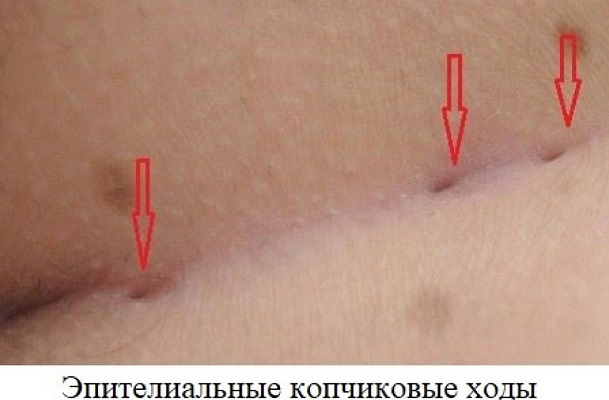 Пилонидальная киста