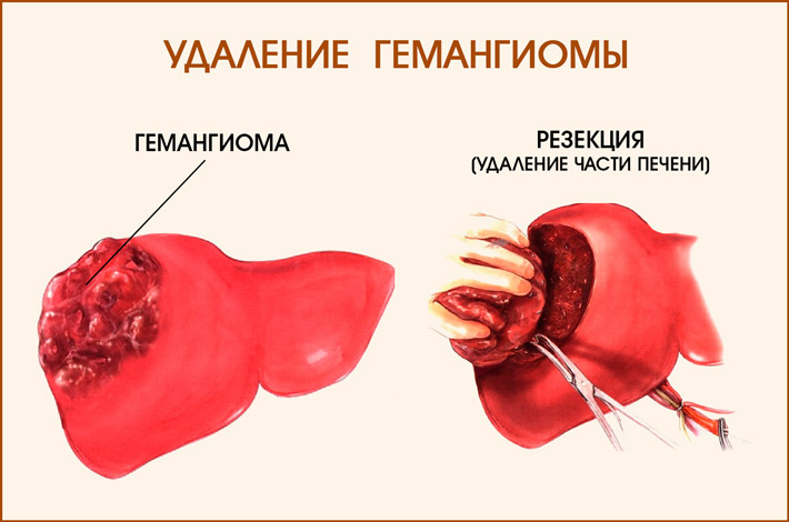 гемангиома печени
