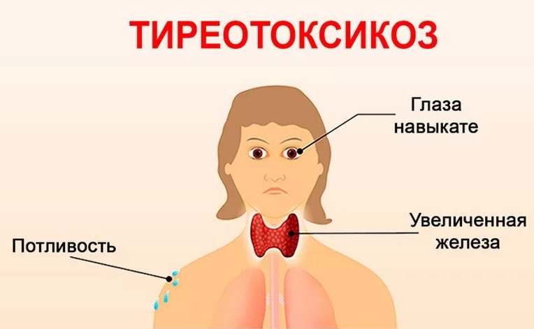 Тиреотоксикоз