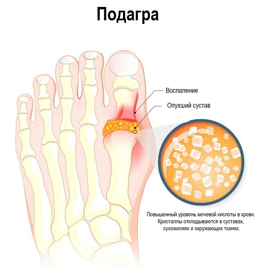 Подагра что это за болезнь