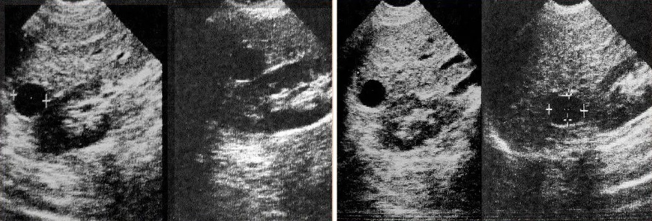 узи кисты печени