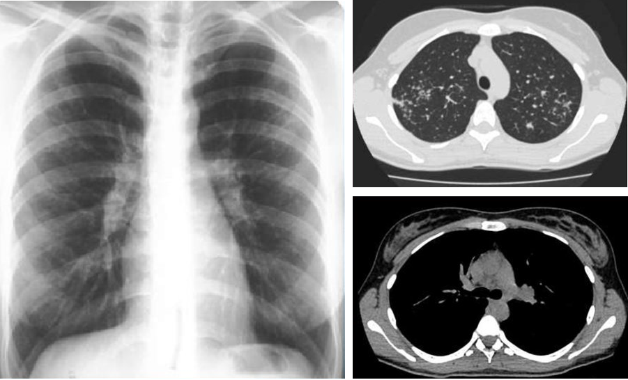 Саркоидоз легких