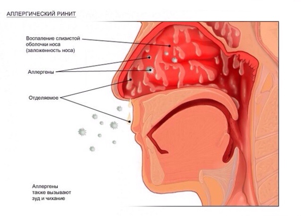 аллергический ринит