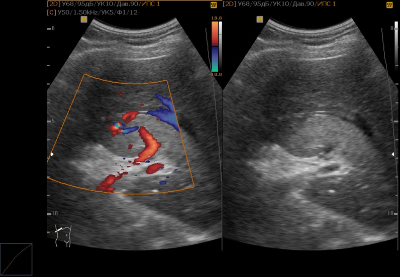 узи гемангиомы печени