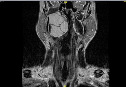 боковая киста шеи