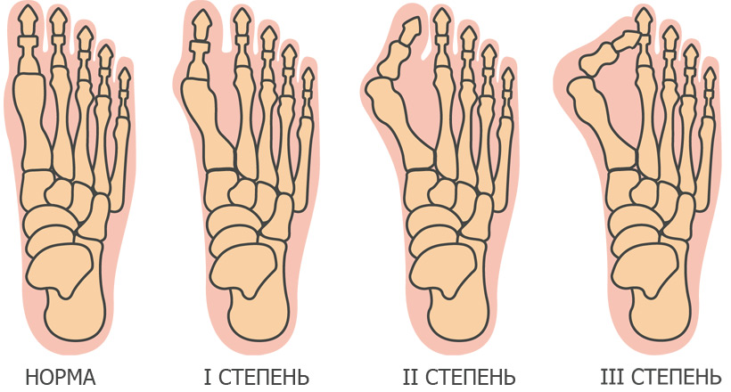 вальгусная деформация стопы