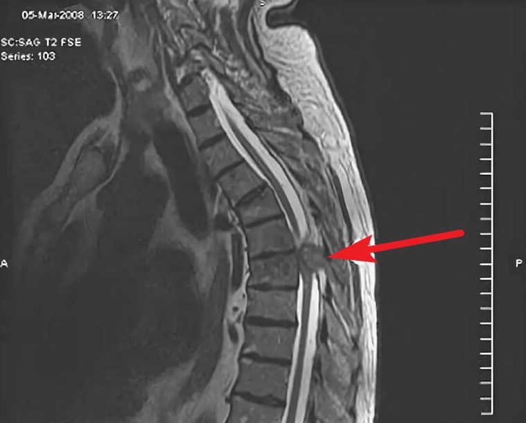 Опухоль спинного мозга