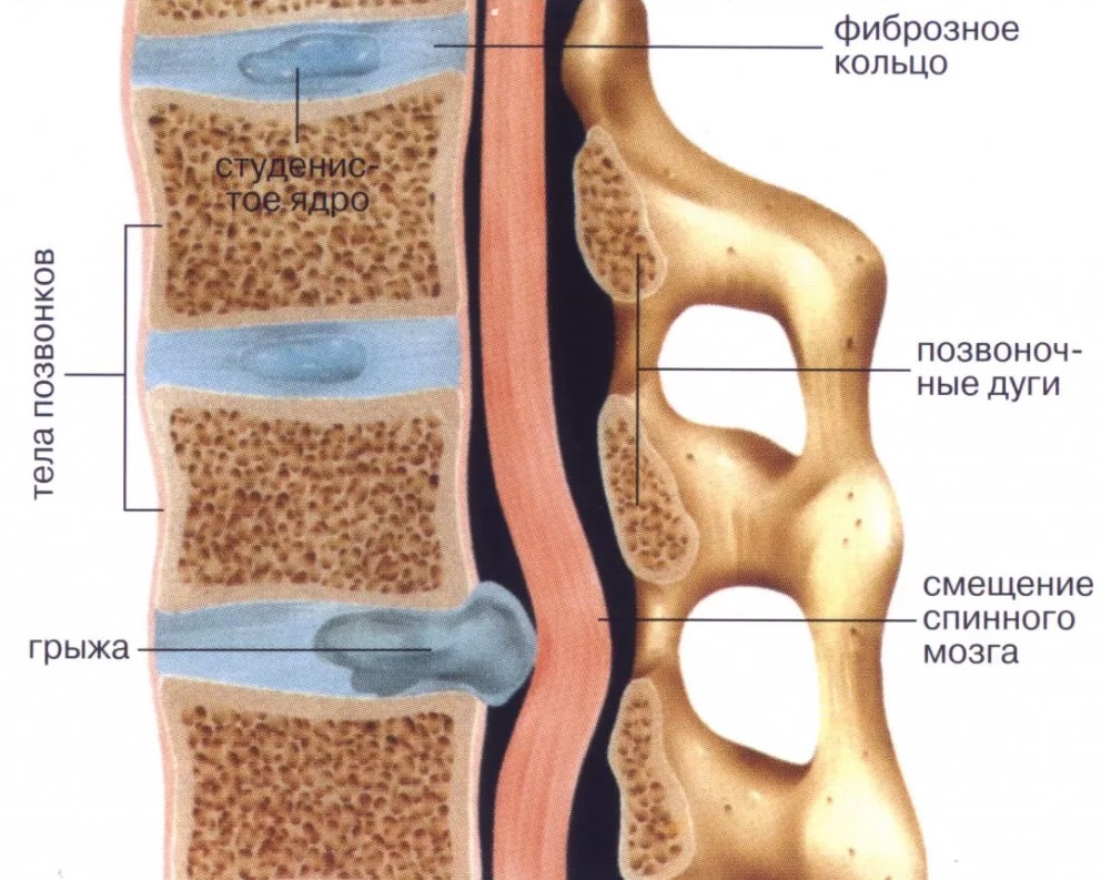 межпозвоночная грыжа