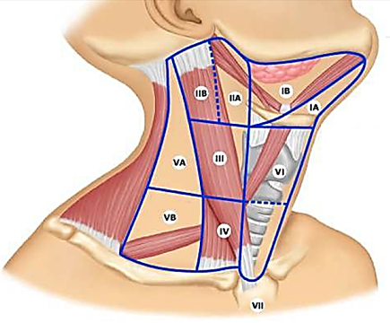 лимфодессекция