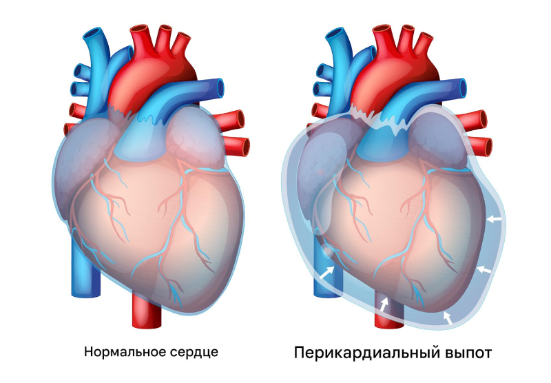 Перикардит симптомы и лечения