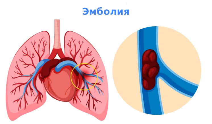 Эмболия сосудов