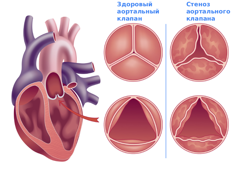 Стеноз аортального клапана степени