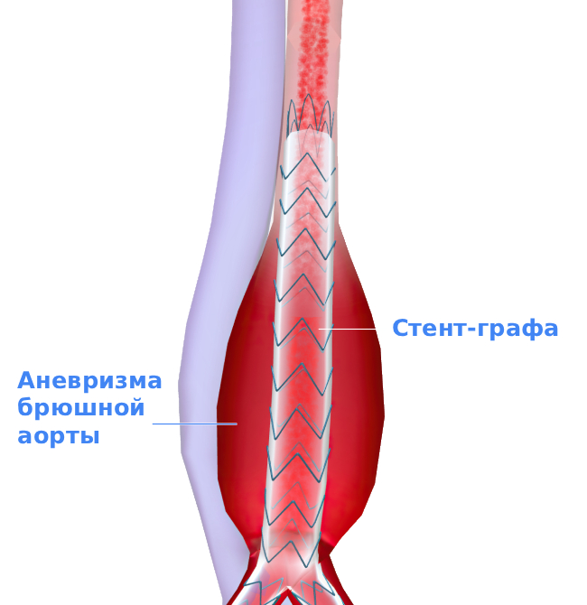 Лечение аневризмы брюшной аорты