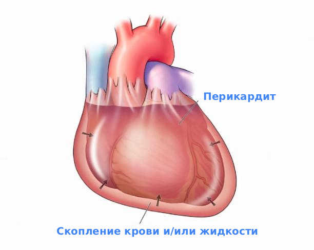 Симптомы тампонады сердца
