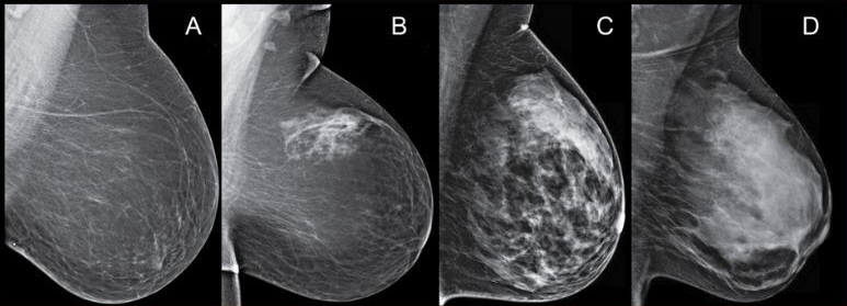 мастопатия_2