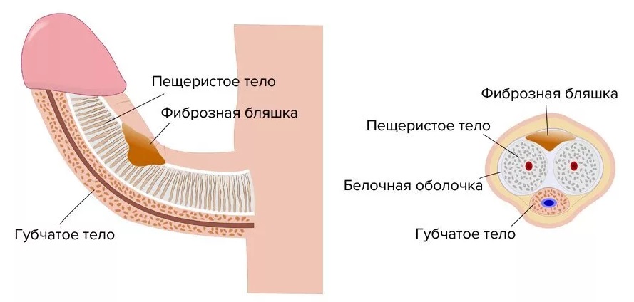 болезнь Пейрони