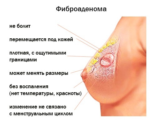 fibroadenoma-molochnoy-zhelezy