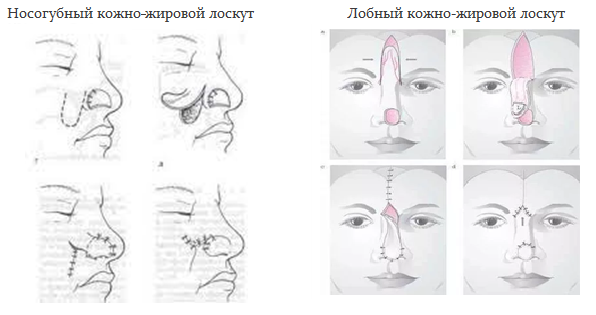 иссечение_3 иссечение_3