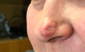 иссечение_2