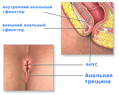 Анальная трещина симптомы