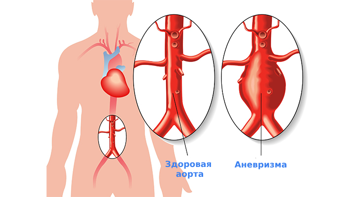 Классификация аневризм аорты