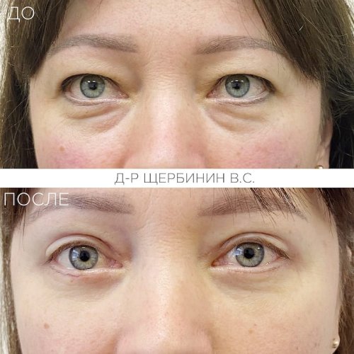 Круговая блефоропластика - до и после Круговая блефоропластика - до и после