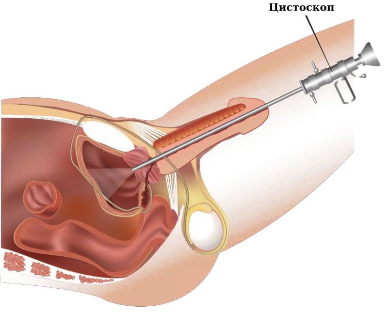 Цистоскопия как проводится Цистоскопия как проводится
