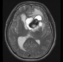Эпендимома головного мозга Эпендимома головного мозга