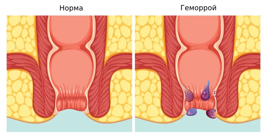 Лигирование геморроя Лигирование геморроя