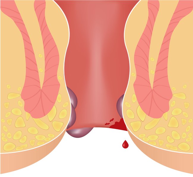 Геморрой у женщин