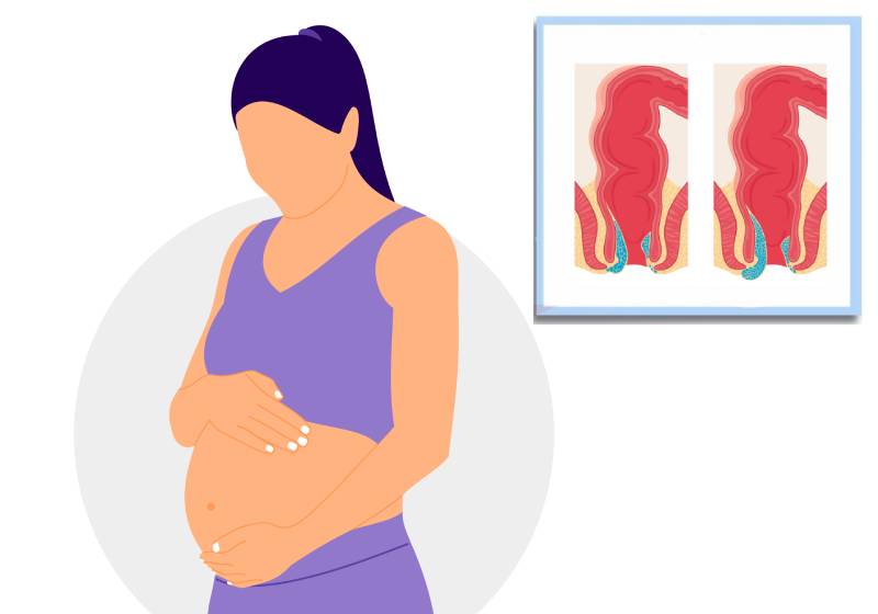 Геморрой у беременных