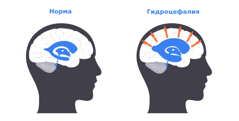 Гидроцефалия Гидроцефалия