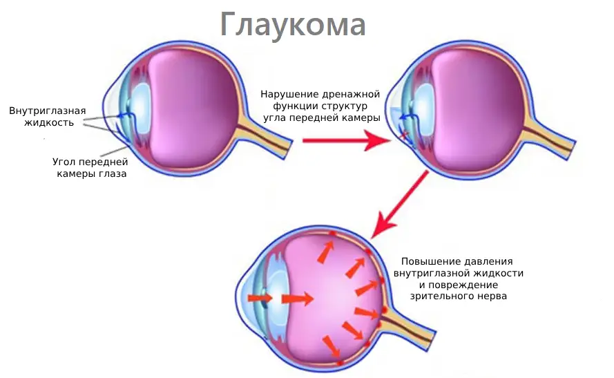 Глаукома