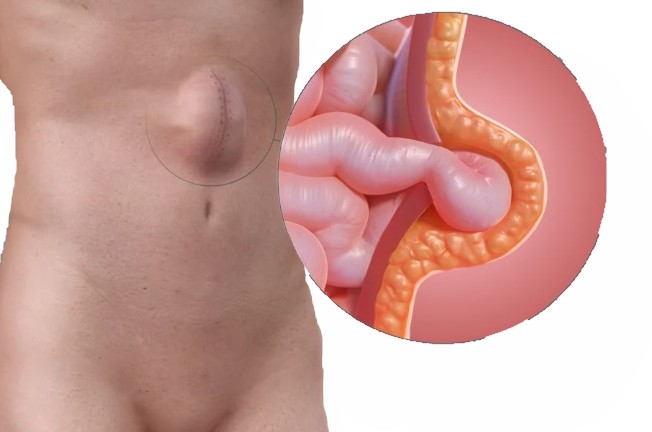 Послеоперационная вентральная грыжа