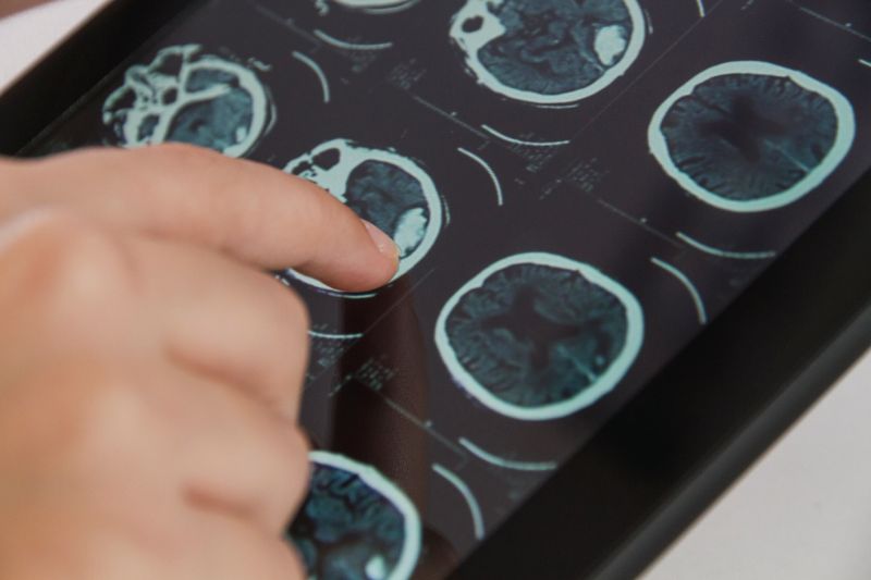 Лечение эпендимомы мозга Лечение эпендиомы мозга